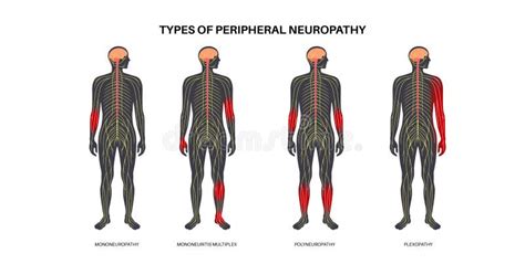 Peripheral Neuropathy Medical Poster Stock Illustration Illustration