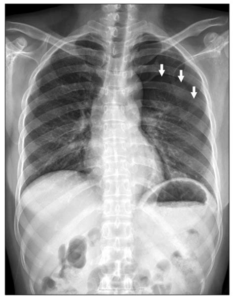 Initial Chest X Ray Shows Pneumothorax In Left Hemithorax White Arrow