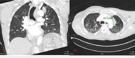 Chest Computed Tomography With Iodine Contrast Coronal And Axial