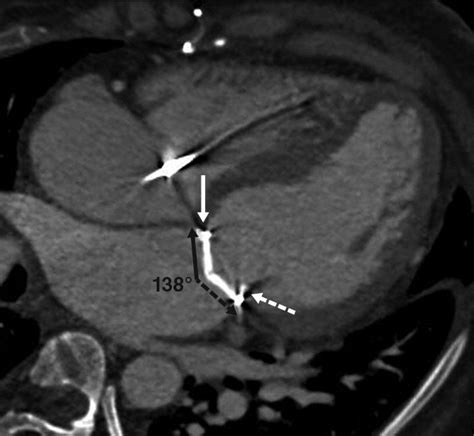 Ecg Gated Mdct After Aortic And Mitral Valve Surgery Ajr