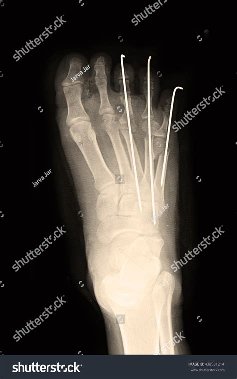 Xray Show Fracture 3rd4th 5th Toes Stock Photo 438531214 Shutterstock