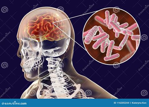 Bacterial Brain Infection Medical Concept Meningitis Encephalitis