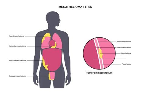 Lung Cancer Stages Mesothelioma Tumor Cells Spreading Respiratory