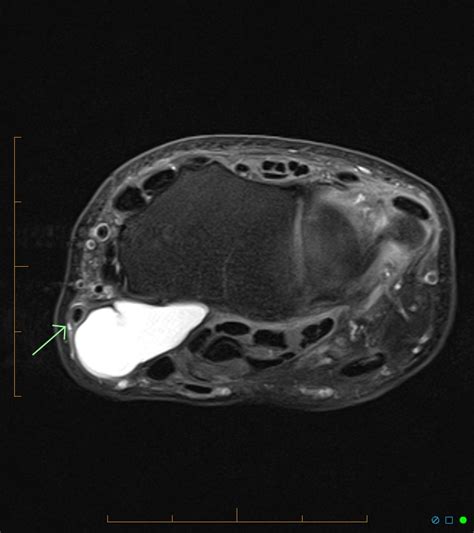 Ganglion Cyst On Arm