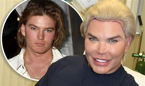 Human Ken Doll Rodrigo Alves Gets A Hair Transplant Daily Mail Online