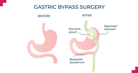 Roux En Y Gastric Bypass Perth Weight Loss Surgery