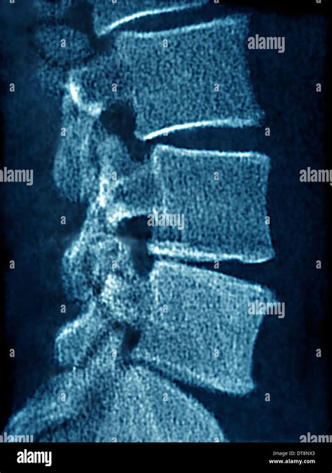 VERTEBRAL OSTEOARTHRITIS X RAY Stock Photo Alamy