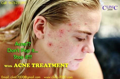 Best Acne Treatment Clinic In Hyderabad Clinic 2000