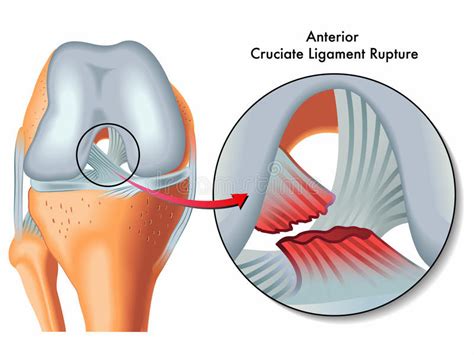 Common Types Of Knee Injuries And Treatment Costa Mesa Physical Therapy