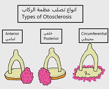 Stapedotomy