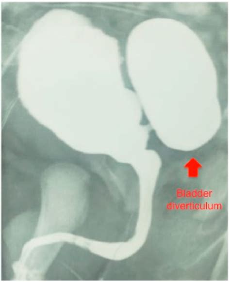 Voiding Cystourethrography Showing A Large Congenital Diverticulum And