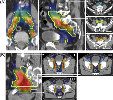 Consensus Delineation Guidelines For Pelvic Lymph Node Radiation