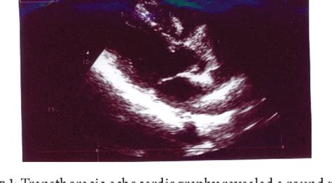 Figure From Cardiac Hemangioma Of Rvot In A Patient With Atypical