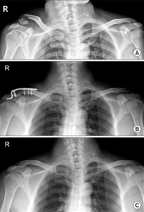 A Neer Type Iib Fracture Of The Clavicle In A 53 Year Old Man Is Download Scientific Diagram