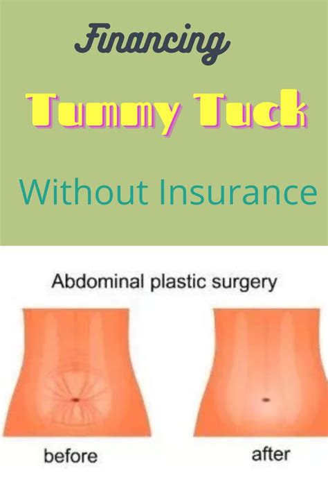 Will Insurance Cover A Tummy Tuck If I Have A Hernia Thi Boucher