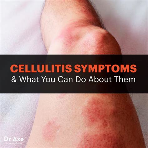 Cellulitis Symptoms Causes And Risk Factors Best Pure Essential Oils