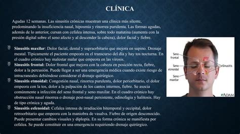 Epistaxis Pptx Medicina Interna Ppt