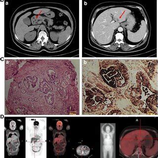 (A) Gastroscopy (April 1, 2020): gastric antrum ulcer. (B) CT (April 1 ...