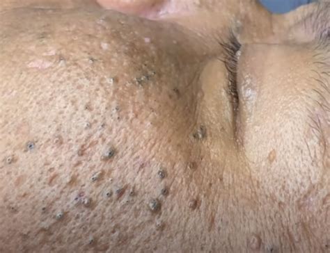 Newest Blackhead Removal Videos Archives New Pimple Popping Videos