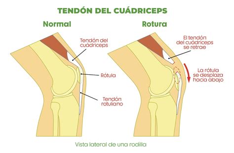 Rotura del tendón del cuádriceps Clínica López Corcuera