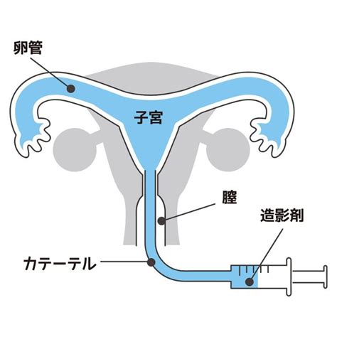 子宮卵管造影検査（不妊症の検査・いつ受けたら良い？）｜さいたま市大宮区のおおのたウィメンズクリニック埼玉大宮