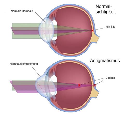 Hornhautverkr Mmung Astigmatismus Augencentrum Dresden De