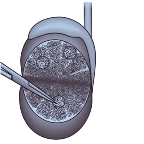 Vasectomy Reversal Vs IVF – Which Is the Best Option for Parenthood ...