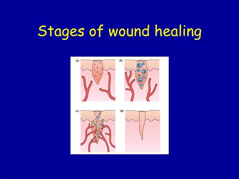 Stages Of Wound Infection