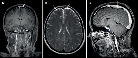 Scielo Brasil Intracranial Hypotension Secondary To Spontaneous