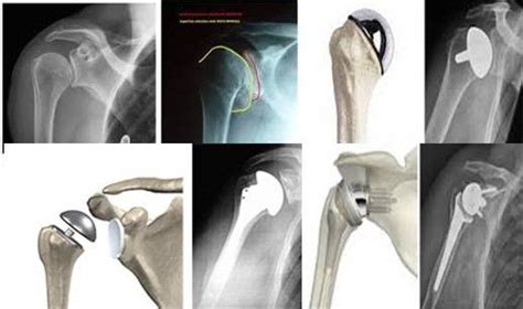 La Protesi Di Spalla Dr Alfonso Manzotti Chirurgia Ortopedica
