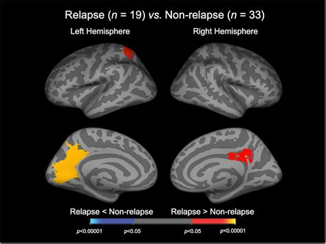 Frontiers Increased Brain Gyrification And Subsequent Relapse In