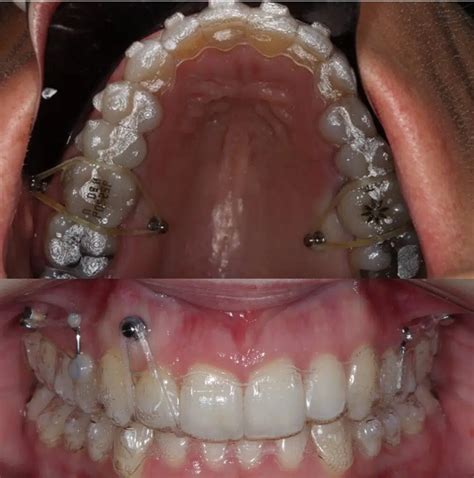 Mini Implantes Aplicação Clínica E Biomecânica Inscrição Growth