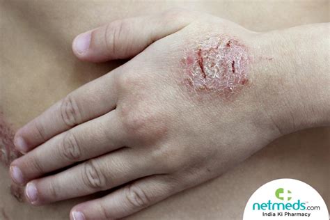 Dyshidrotic Eczema Dyshidrosis Symptoms Causes Treatments