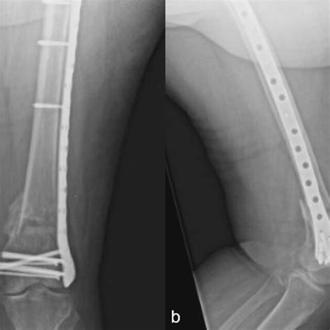 Anteroposterior A And Lateral B Radiographs Of Retrograde Download Scientific Diagram