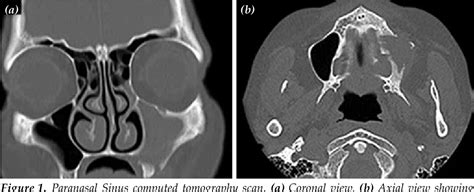 Figure 1 From Closure Of Oroantral Fistula With Nasal Septal Cartilage