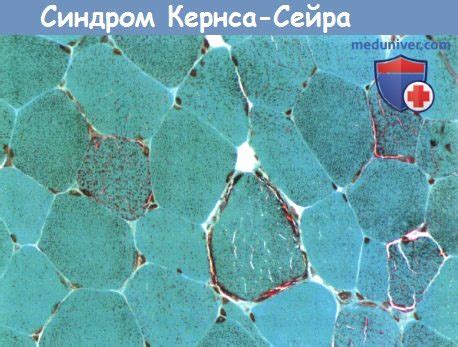 Синдром кернса сейра презентация