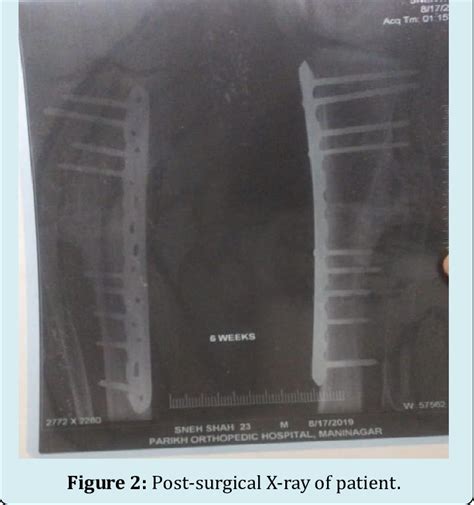 Multiple Exostoses In X Ray Pre Surgical Download Scientific Diagram