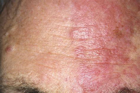 Shingles Rash Stock Image M2600323 Science Photo Library