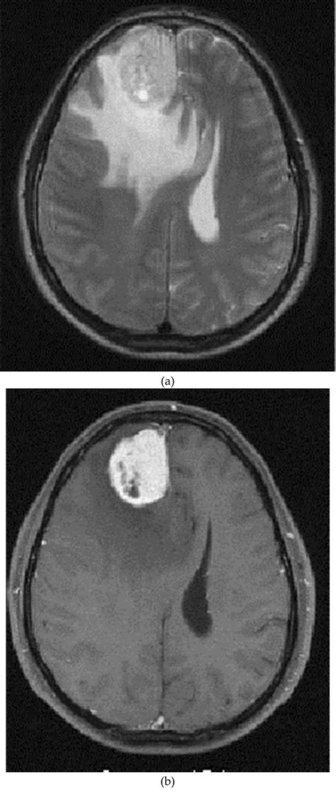 Frontal Lobe Tumor Surgery