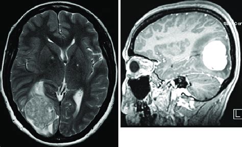 Preoperative Axial Precontrast T Weighted Left And Axial T Weighted