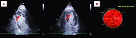 Two Dimensional Transthoracic Echocardiography D Tte Performed In