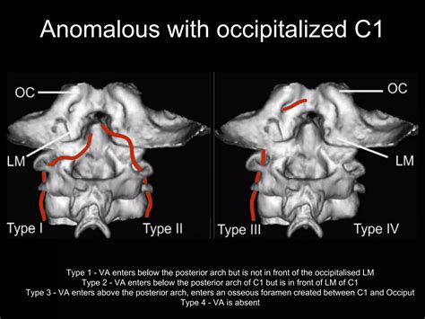 Applied Surgical Anatomy Of The Craniovertebral Spine PPT