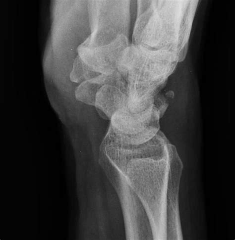 Triquetral fracture | Radiology Case | Radiopaedia.org | Radiology, Fracture, Radiology imaging