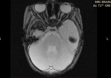 Pre Embolization MRI Axial T2 GRE Sequence Verifying The Existence