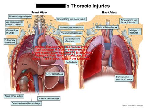 Amicus Illustration Of Amicus Injury Thoracic Bilateral Lung Collapse