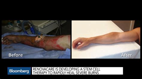 Severe Burn Victims Before And After