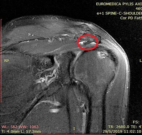 Subacromial Impingement Syndrome George D Goudelis Md Ph D