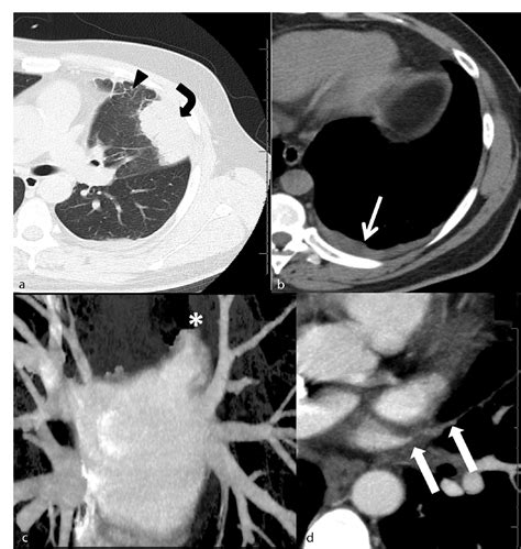 Figure 2 From Pulmonary Vein Occlusion And Lung Infarction Complicating Non Treated Moderate