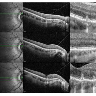 Optical Coherence Tomography Oct Scans In A Year Old Male Myopic