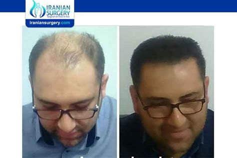 Hair Transplant In Iran Before And After Hair Transplant In Iran Pictures